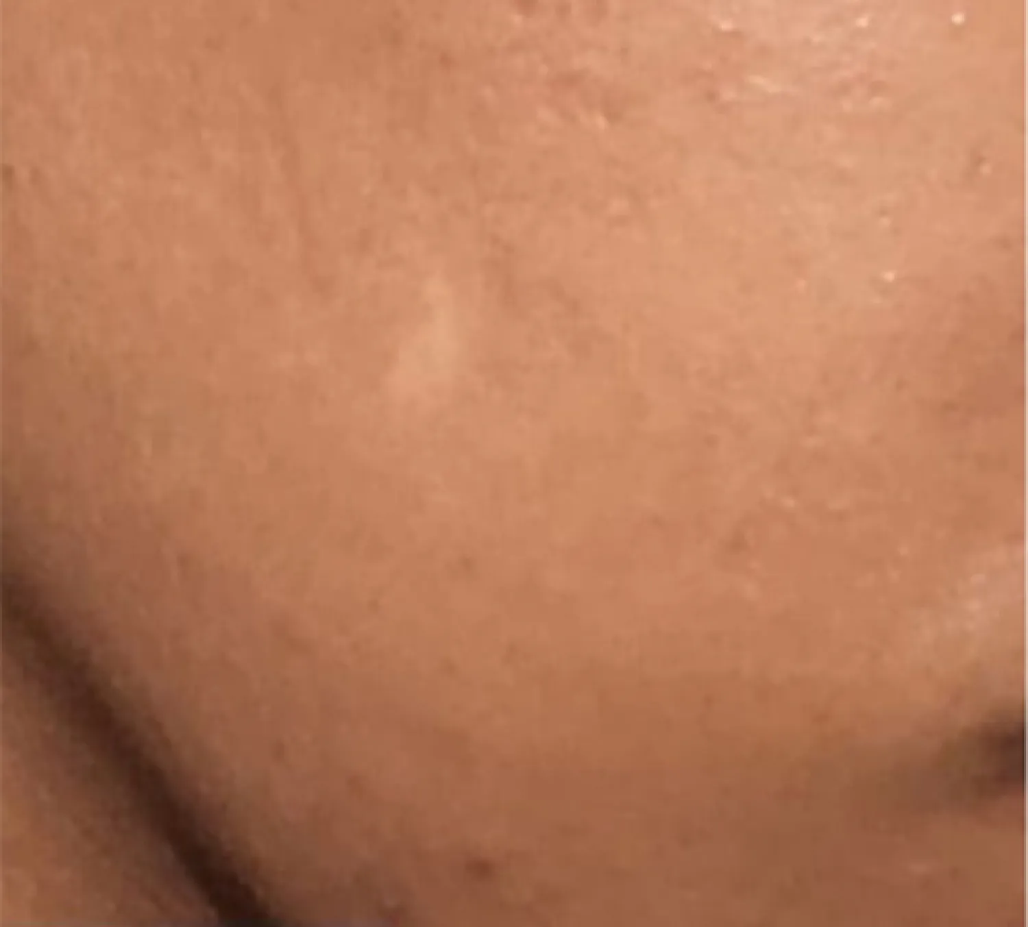 Close up of skin after using PanOxyl