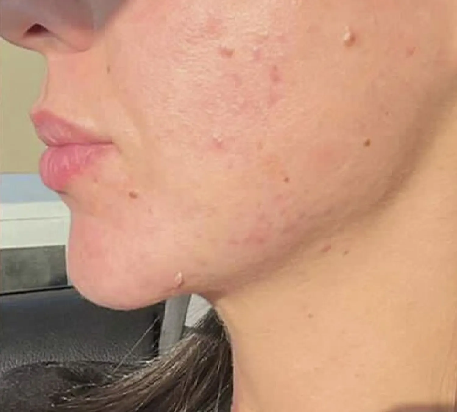 Close up of skin after using PanOxyl