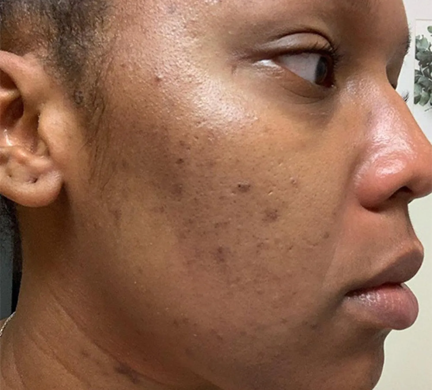 Close up of skin before using PanOxyl