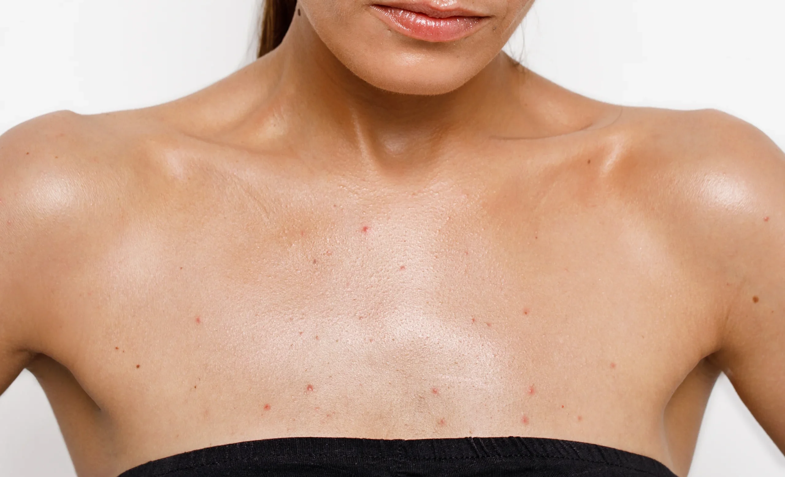 What Causes Chest Acne How To Get Rid Of Chest Acne Panoxyl