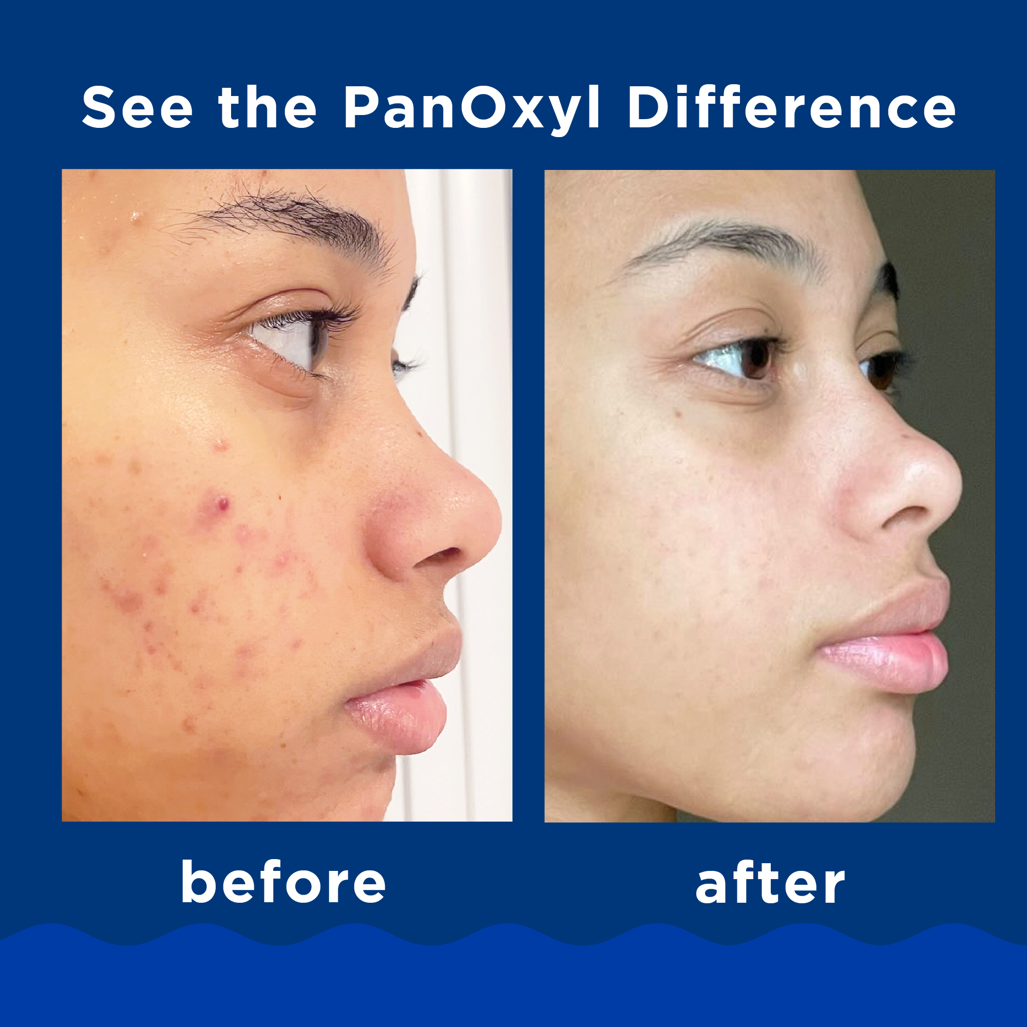 Before and after image of PanOxyl Acne Foaming Wash user, showing clearer skin in the after photo. See the PanOxyl difference.