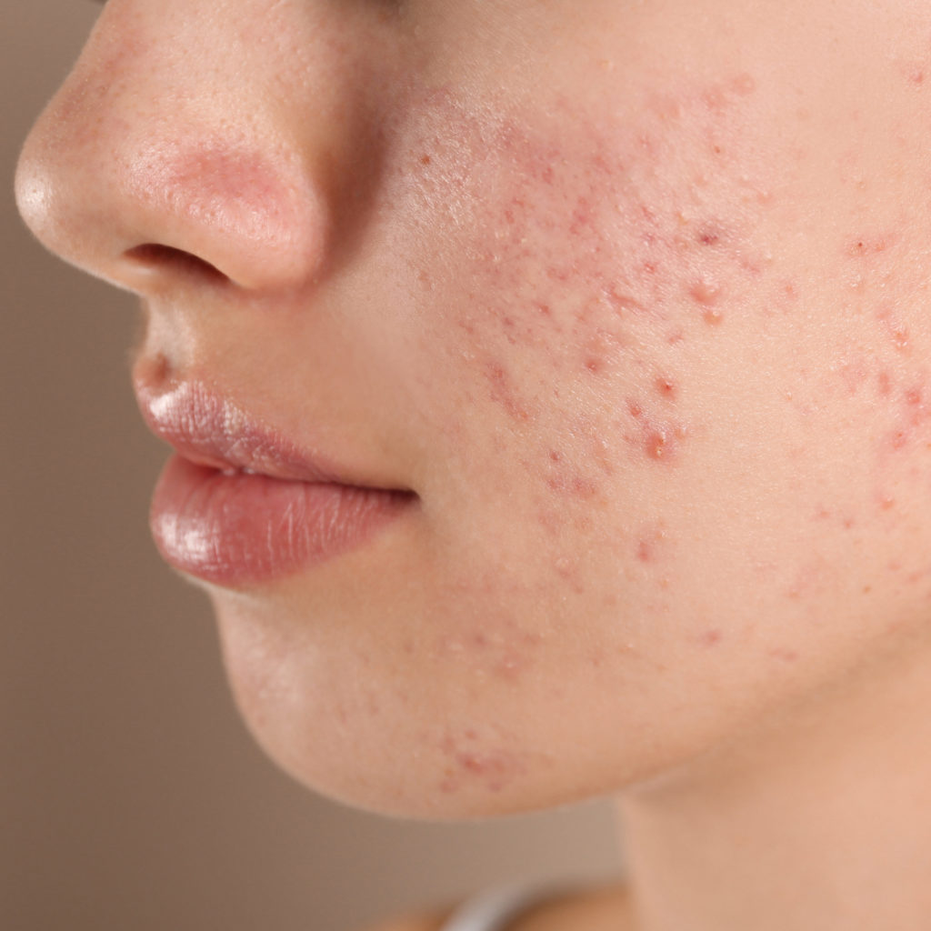 Face with an acne-breakout