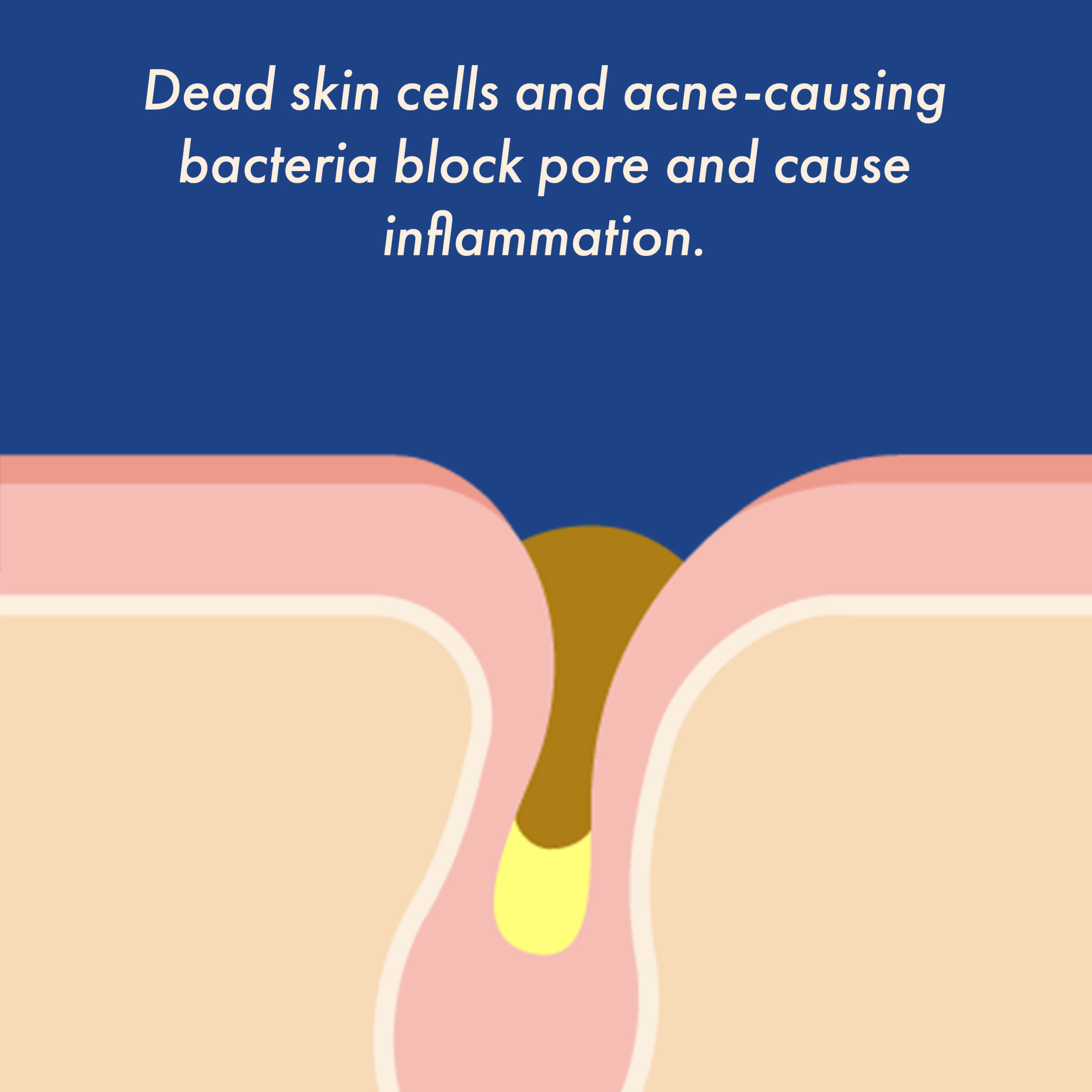 Dead skin cells and acne-causing bacteria block pores and cause inflammation.