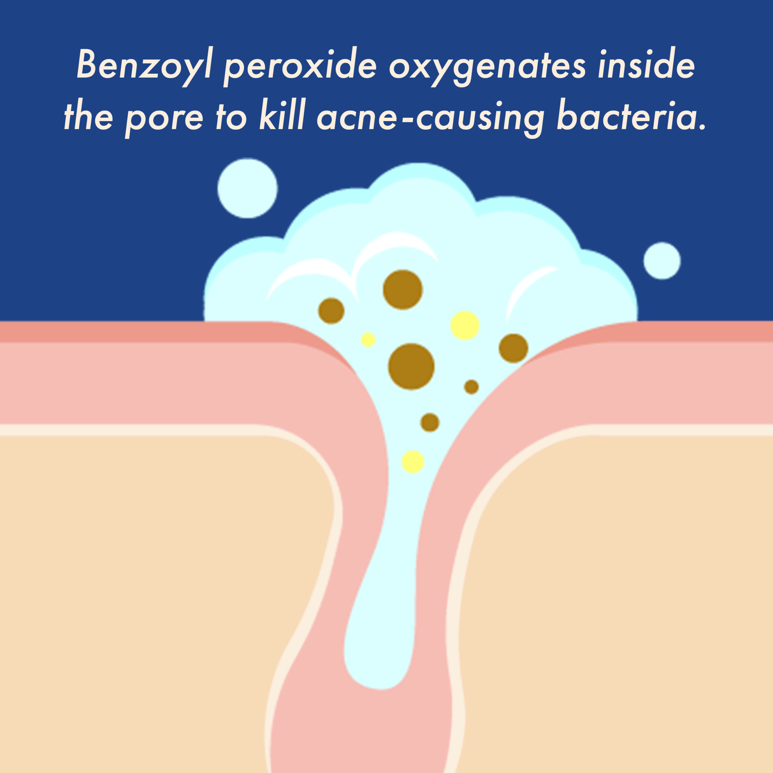 Benzoyl peroxide oxygenates inside the pore to kill acne-causing bacteria.