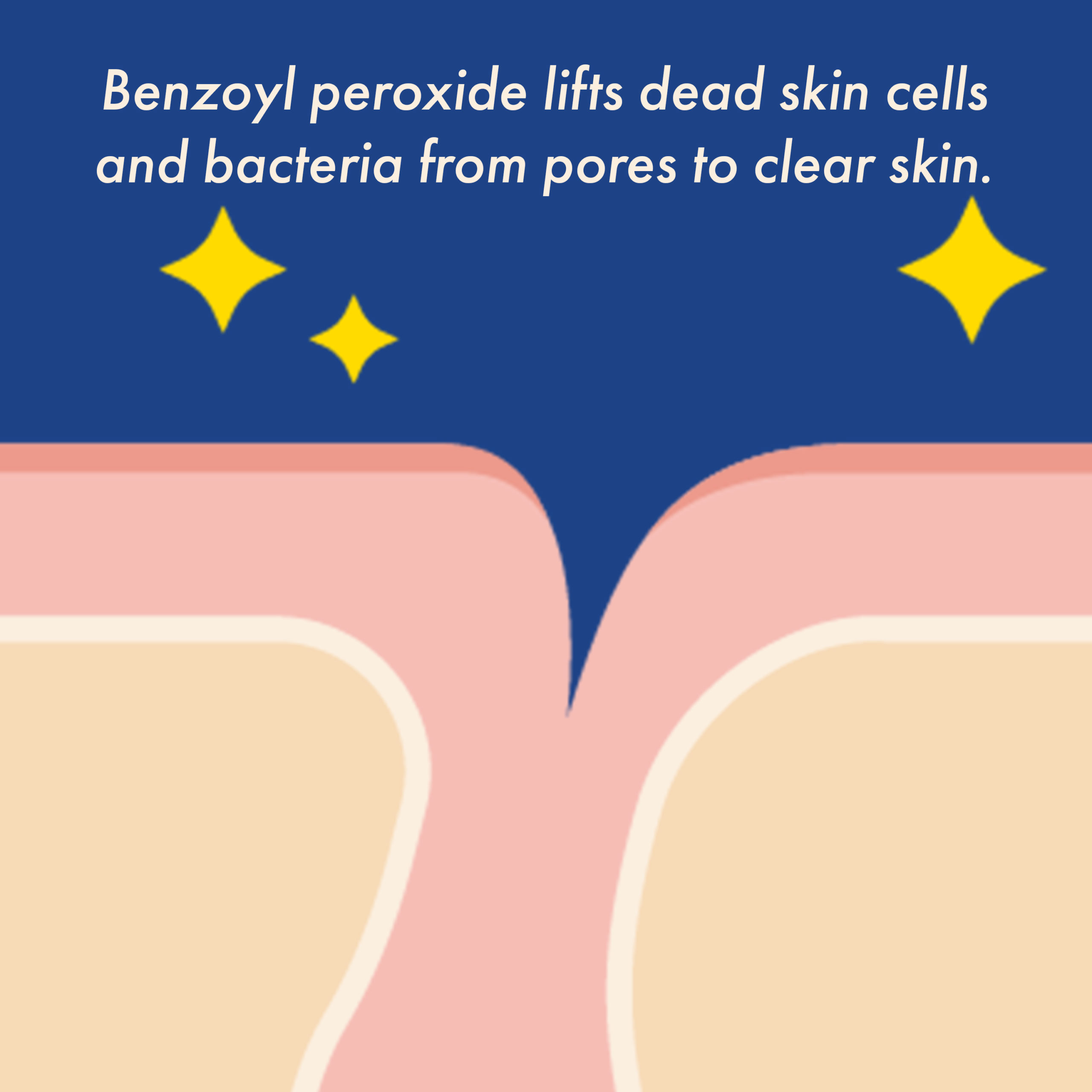 Benzoyl peroxide lifts dead skin cells and bacteria from pores to clear skin.