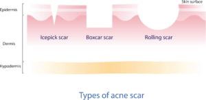 Acne scar illustration; Icepick scars are deep, narrow pitted scars. Boxcar scars look like a large pore and have sharply defined edges. Rolling scars are shallow and give the skin a wavy appearance.