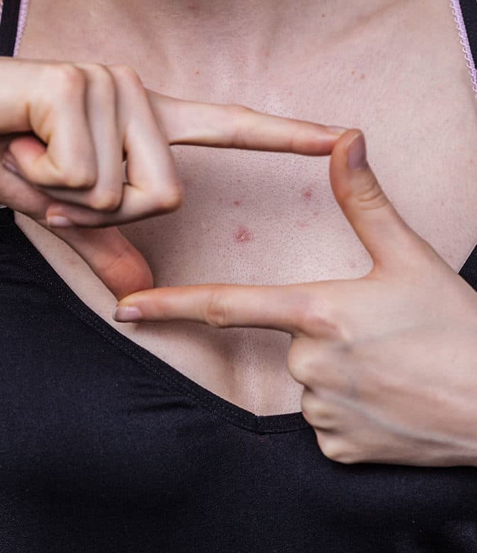 Chest Acne: Why You Have It & How To Treat It Holistically? – Vedix