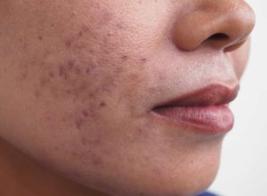 Hyperpigmentation on a woman's face