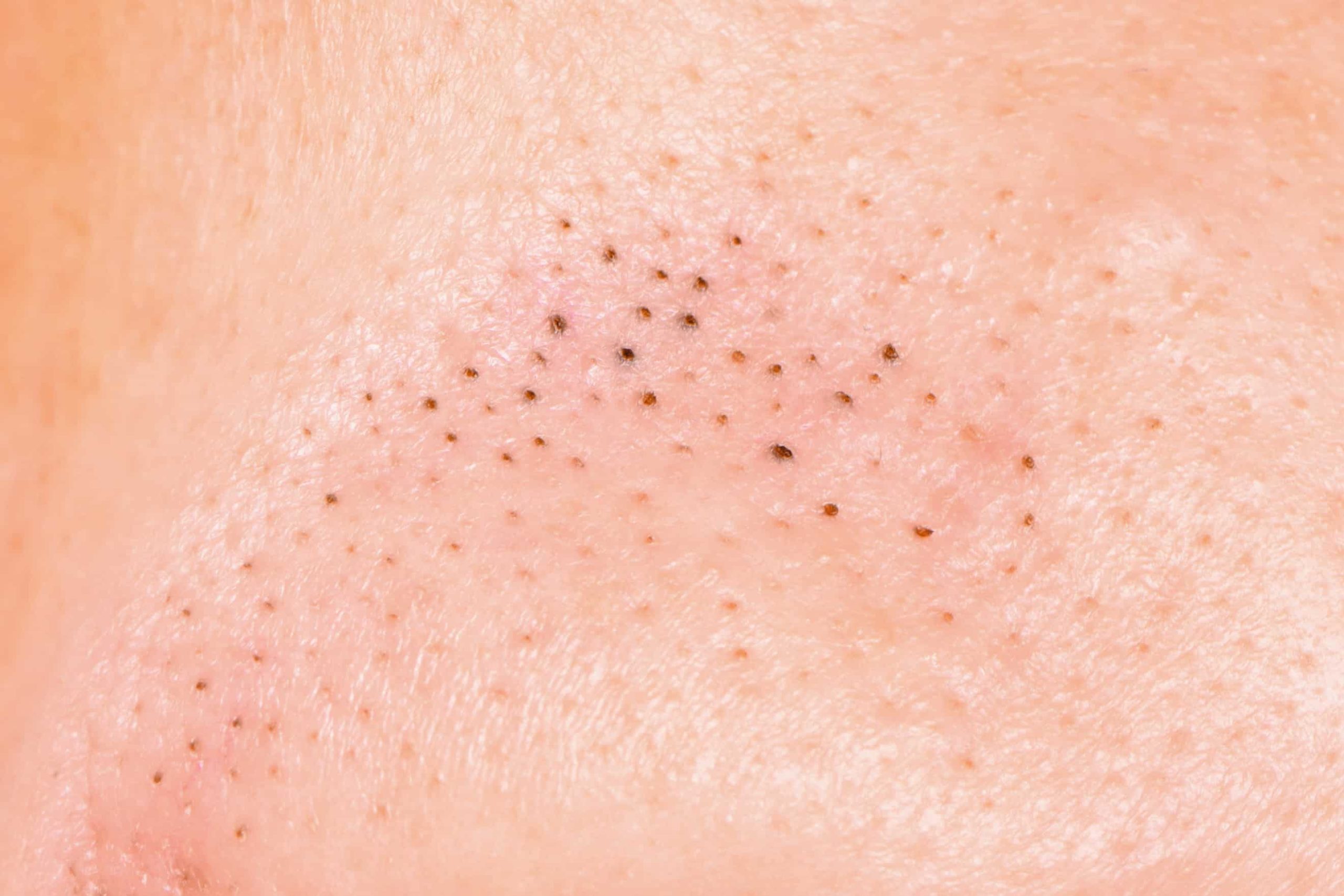 Blackheads appear as little black dots in the skin