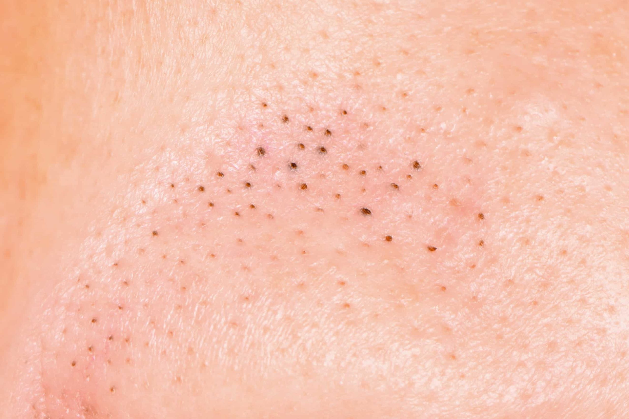 Big Blackhead Popping Videos