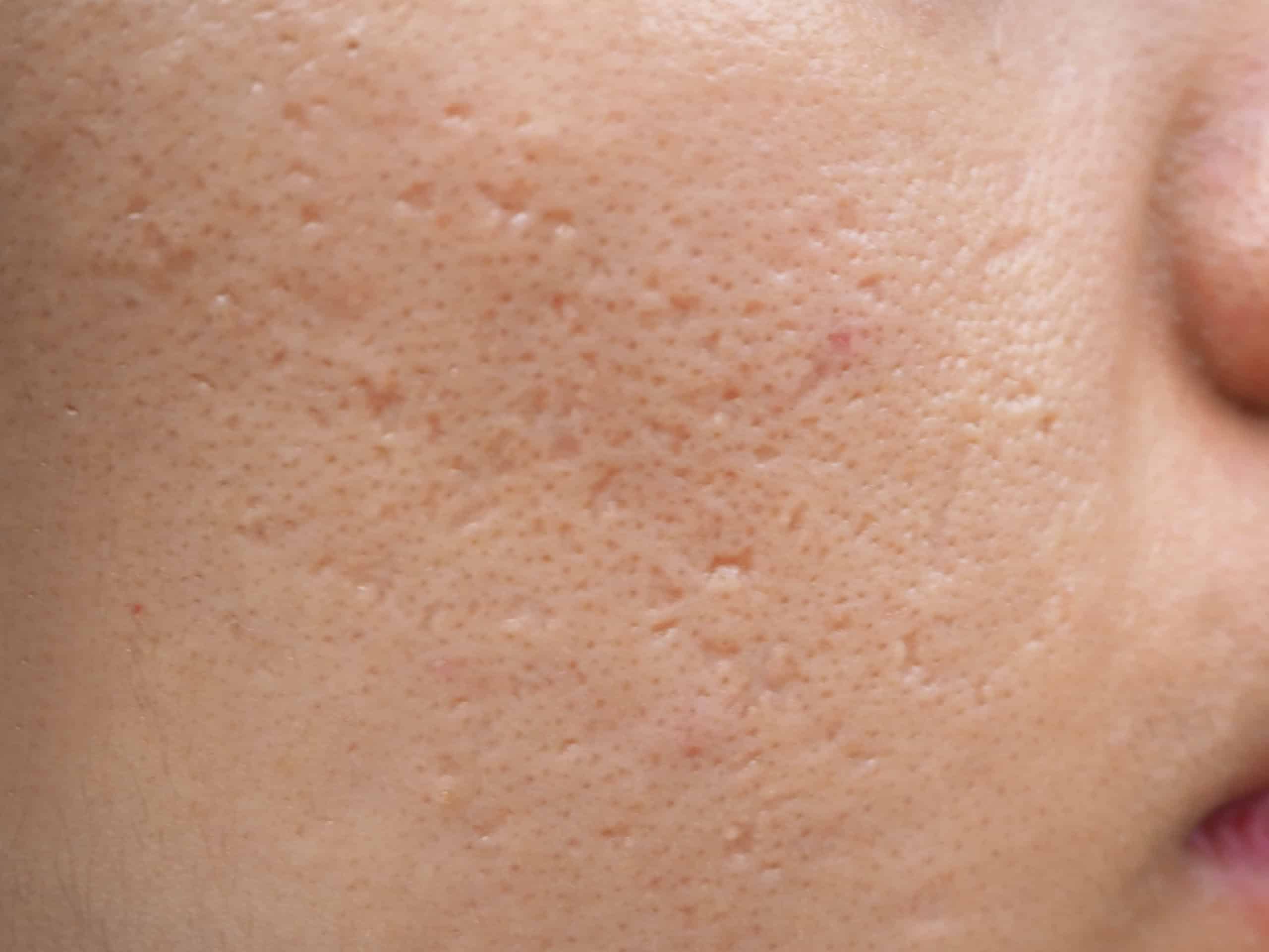 How To Get Rid Of Acne Scars And Dark Spots PanOxyl