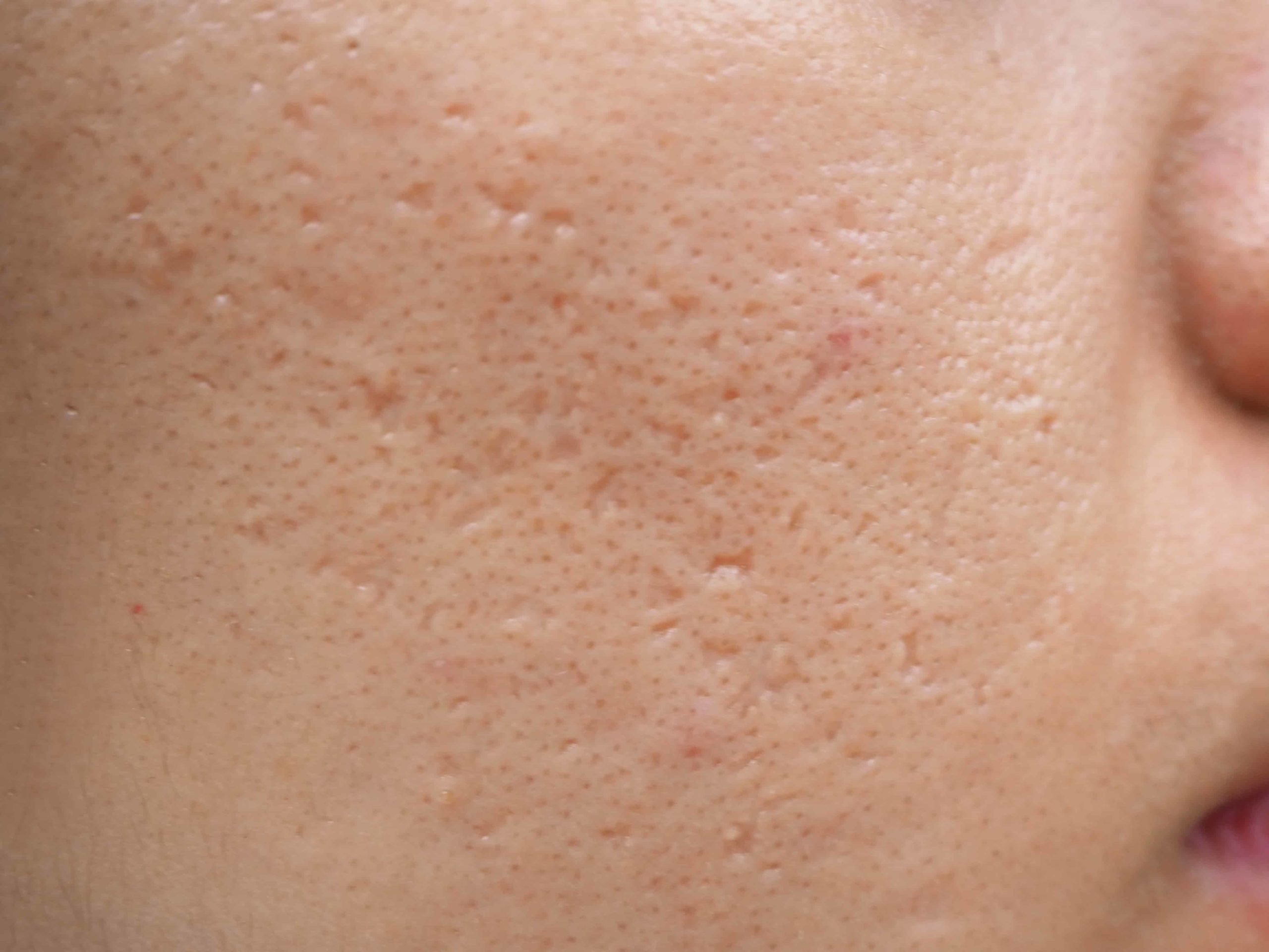 Acne scars shown on a woman's face