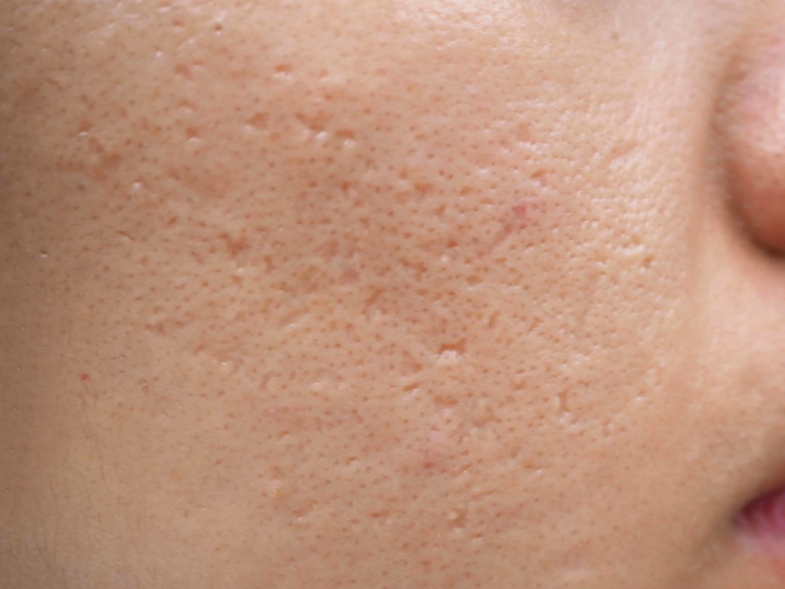 acne dark spots on face